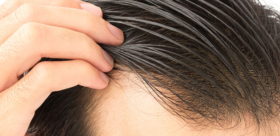 Fem saker att tänka på innan du gör en hårtransplantation